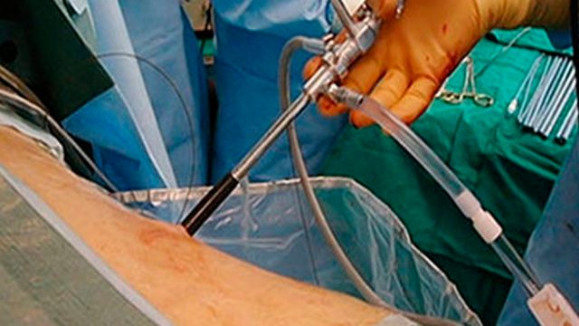 En Hospital Clínico del Sur se realiza exitosa Cirugía Renal Percutánea